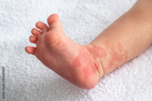 Foto Hemangioma red birthmark on the leg of newborn baby