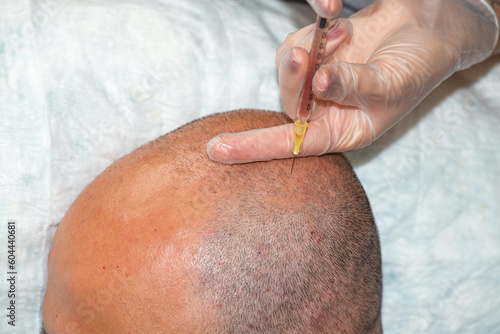 Hair transplantation and PRP application. PRP application to strengthen the hair follicle.