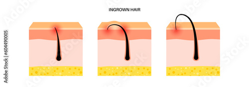 Ingrown hair inflammation