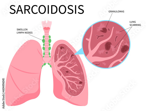 Lung cancer lupus pulmonary fibrosis Sarcoidosis and granuloma amyloidosis tuberculosis of skin eye lymph node uveitis with pernio systemic inflammatory