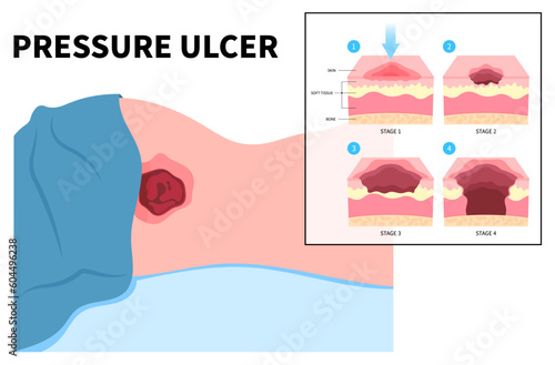 Lying down or sitting prolonged period time with paralysis patient cause Bedsores pressure ulcer injury skin underlying tissue from immobility adults photo