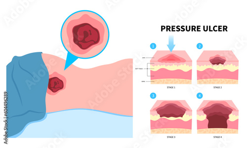 Symptom of paralysis patient and immobility adults with Bedsores pressure ulcer injury skin underlying tissue from lying down or sitting prolonged period time photo