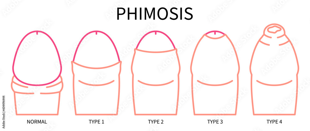 Medical Anatomy Of Paraphimosis For Phimosis Swelling Pain With HSV And Medical Anatomy Of Paraphimosis For Phimosis Swelling Pain With HSV And