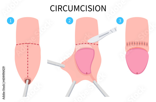 Medical anatomy of Circumcision paraphimosis for phimosis swelling pain with HSV and HPV or Herpes simplex virus Redness itchy prepuce Genital candidiasis yeast bacteria preputial adhesion photo