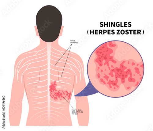 Shingles Herpes Zoster virus on body and skin itching rash blister sores of varicella chickenpox pain torso Vaccine photo