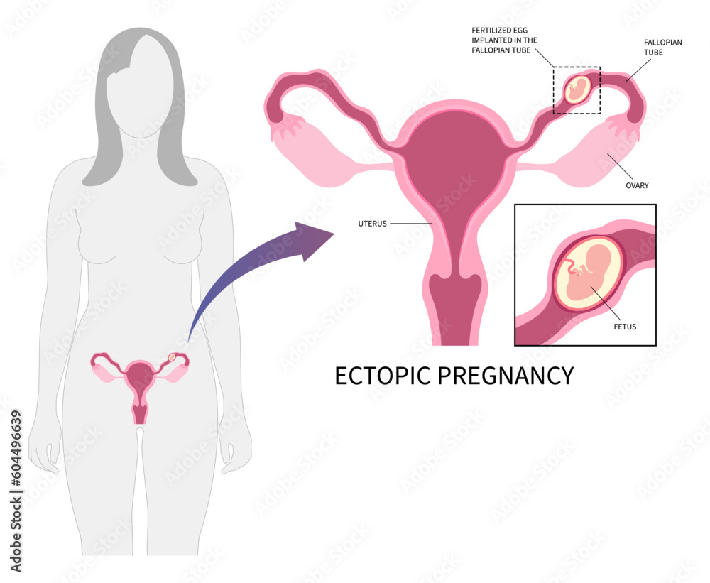 Medical anatomy for IVF or In vitro Fertilisation in the miscarriage with blocked fallopian tube of Ectopic pregnancy abortion or blighted ovum and ovaries womb by fertilized