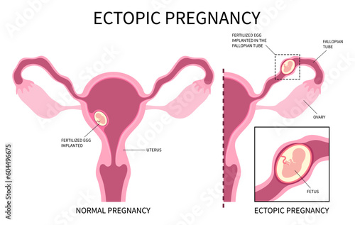 miscarriage with blocked fallopian tube of Ectopic pregnancy abortion or blighted ovum and In vitro Fertilisation ovaries womb by fertilized