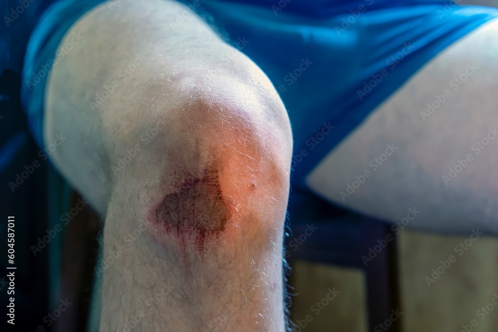 bruised knee, first aid for knee injuries, Treatment of knee injuries ...