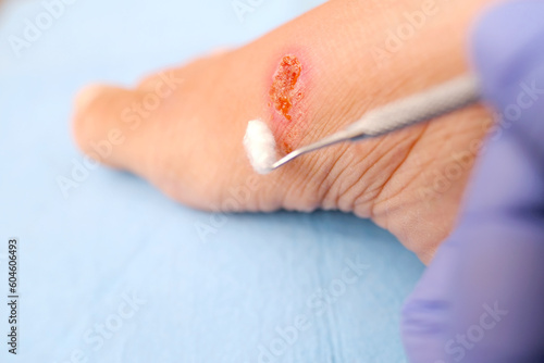doctor treats weeping wound, trophic ulcer on female leg, wound exudate prevents healing ulcers by destroying growth factors, concept eliminating inflammatory process, sanitation pathogenic microflora photo