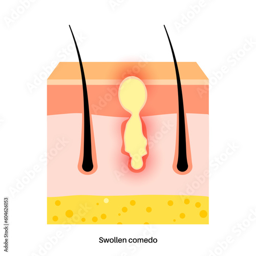 Acne treatment poster