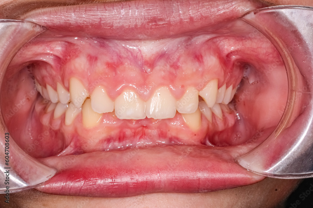 Fototapeta Frontal View Of Dental Maxillary And Mandibular Arches In