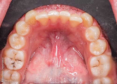 Dentistry case with crooked anterior teeth and molar caries. Lip retracted with black contraster, lower mandibular arch directly above occlusal view with tongue retracted, lingual frenulum and saliva. photo