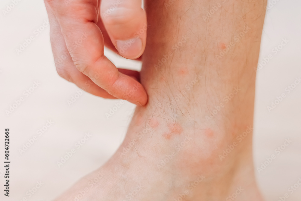 Close up man scratching with hand allergic rash on leg. Leg with red rash caused by insect bites. Dermatitis, folliculitis, fungal infection. Affected area of red and blotchy and to swell skin Close up man scratching with hand allergic rash on leg. Leg with red rash caused by insect bites. Dermatitis, folliculitis, fungal infection. Affected area of red and blotchy and to swell skin