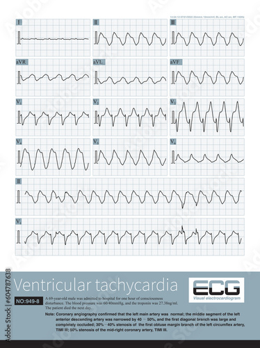 A 69 year old patient with acute anterior and inferior myocardial infarction developed a series of electrocardiograms of ventricular tachycardia, and ultimately died in the hospital.