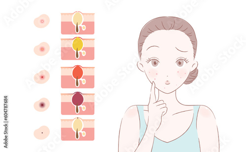 エステ・美容サロンにぴったりのお団子ヘアーのニキビで悩む女性のイラストと肌表面・肌断面セット_フェミニン手描き風ベクター_水色系