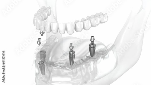 Mandibular prosthesis all on 4 system supported by implants. Dental 3D animation