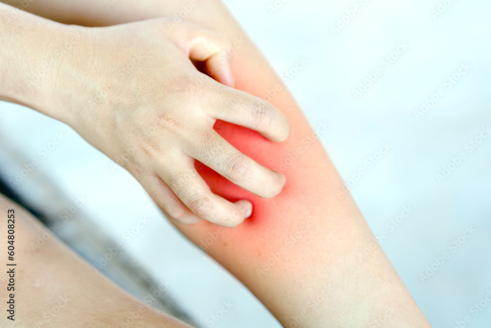 A woman scratching her itchy leg from an insect bite or having allergies. Health care concept.