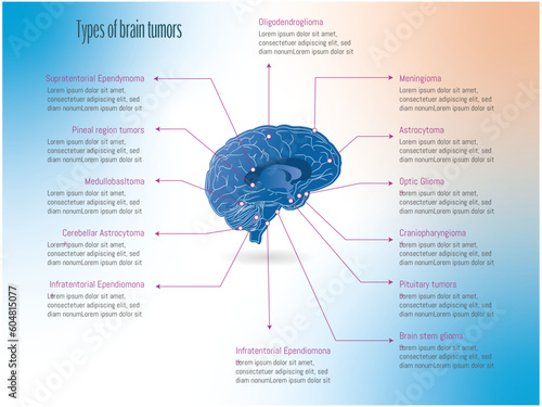 Types of brain tumors according to the affected area.illustration of a brain with points marked according to the tumor on a white and colored background.