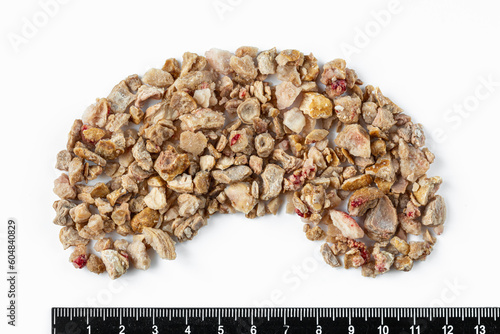 Kidney stones. Stones were removed from the patient's kidneys