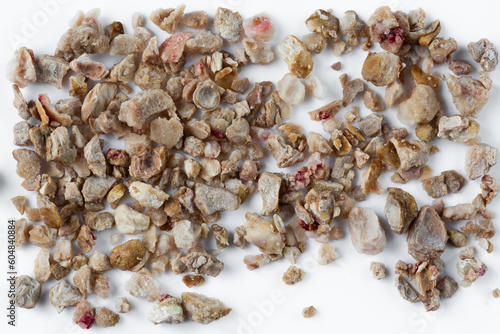 Kidney stones. Stones were removed from the patient's kidneys photo