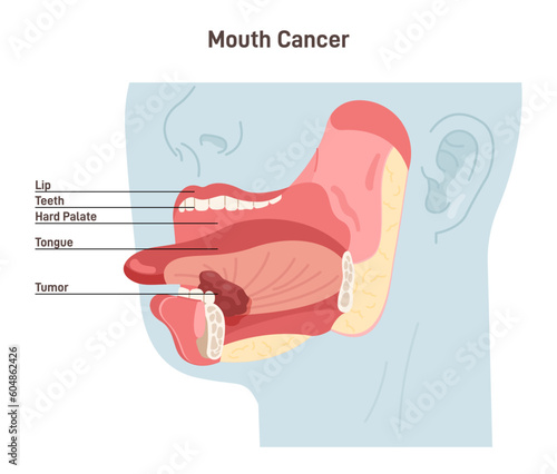 Mouth cancer. Malignant inflammation of oral cavity. Tongue carcinoma.
