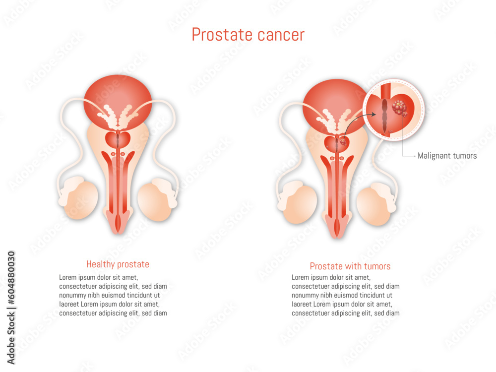 Prostate cancer infographic on white background illustration. Anatomy ...