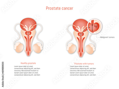 Prostate cancer infographic on white background illustration. Anatomy of male reproductive organs. Healthy prostate and cancer. 