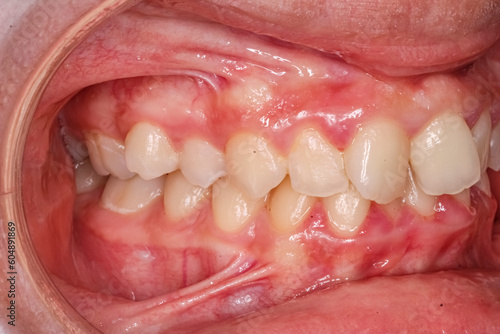 Dental maxillary and mandibular arches in occlusion with biting crooked teeth, anterior diastema gap between central incisors and gingival gum frenulum. Oblique direct side view with cheek retractor.
