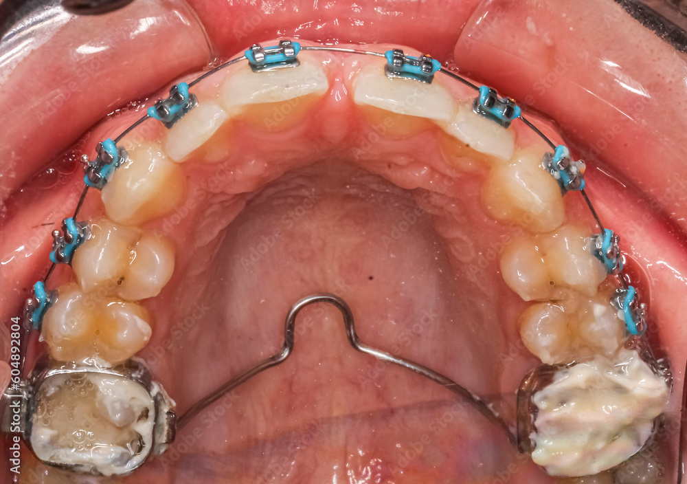 Dental orthodontics braces with blue colored elastic ligatures, NiTi