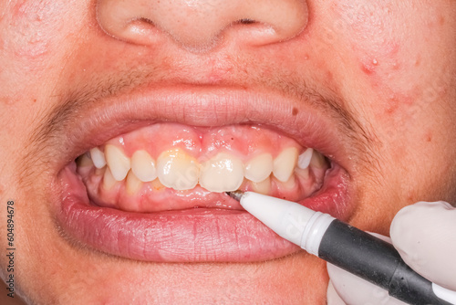 A dentist calculating the deep bite length of a patient holding a pen marker with gloves and marking a trace a on the lower tooth. Frontal view of a young man open mouth biting teeth dentistry case.
