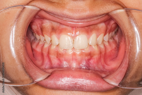 Frontal view of dental maxillary and mandibular arches in occlusion with anterior excessive overbite deep biting teeth aligned, lips retracted with cheek retractor. Healthy gingival gum and no decay photo