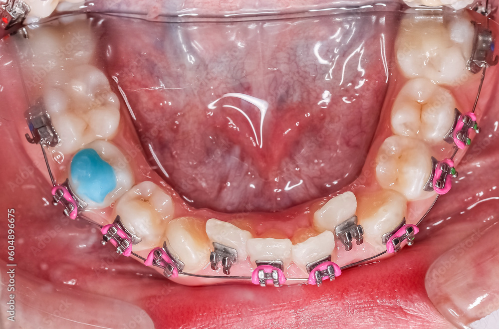 Foto Stock Occlusal of dental arches in occlusion with deep overbite