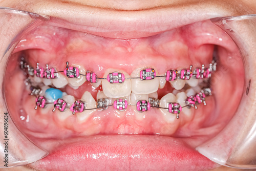 Frontal view of dental arches in occlusion with deep overbite biting teeth, bite-raising blue resin on molars , orthodontic braces, metallic arch wire, cheeks and lips retracted with cheek retractor. 