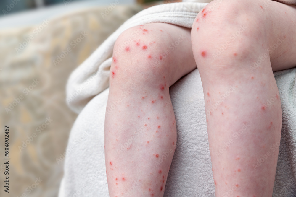 Skin rash on the legs of a small child. Ulcers from scratching. Acute viral disease of coxsackie. Allergic reaction. Skin rash on the legs of a small child. Ulcers from scratching. Acute viral disease of coxsackie. Allergic reaction.