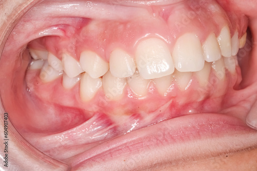 Frontal view of dental maxillary and mandibular arches in occlusion with anterior deep biting teeth, cheeks and lips retracted with cheek retractor. Healthy gingival gum and no decay. photo