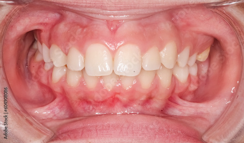 Frontal view of dental maxillary and mandibular arches in occlusion with anterior deep biting teeth, cheeks and lips retracted with cheek retractor. Healthy gingival gum and no decay.