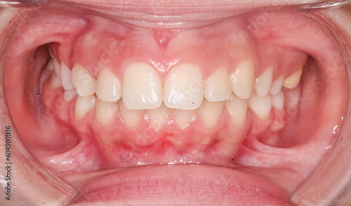 Tableau sur toile Frontal view of dental maxillary and mandibular arches in occlusion with anterior deep biting teeth, cheeks and lips retracted with cheek retractor