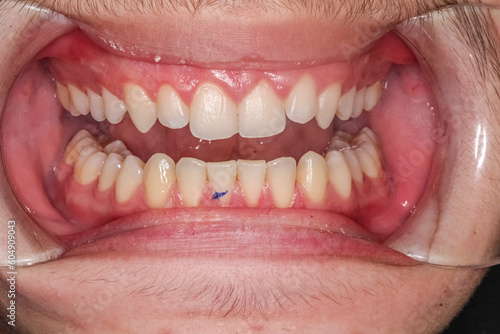 Frontal view of a unrecognisable young dentistry case man open mouth with a trace a on the lower tooth made by a a pen marker to calculate the deep bite length.