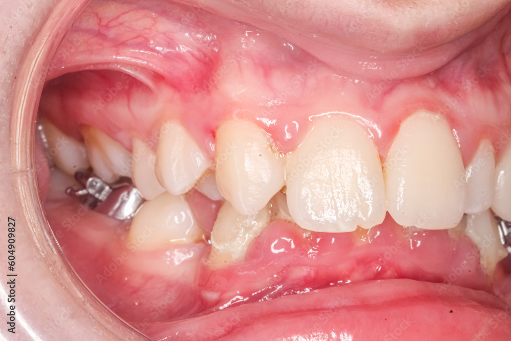 Frontal view of dental maxillary and mandibular arches in occlusion with anterior deep biting teeth, cheeks and lips retracted with cheek retractor. Healthy gingival gum and no decay.