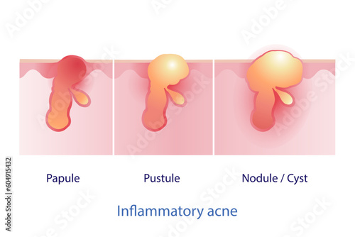 Types of inflammatory acne vector on white background. Papule, pustule, nodule and cyst. Skin care and beauty concept illustration. photo