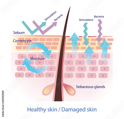 Comparison of healthy and damaged skin barrier vector on white background. The healthy sebum barrier protect skin from stimulation and bacteria. When sebum decreased, lead to more water leaving skin.