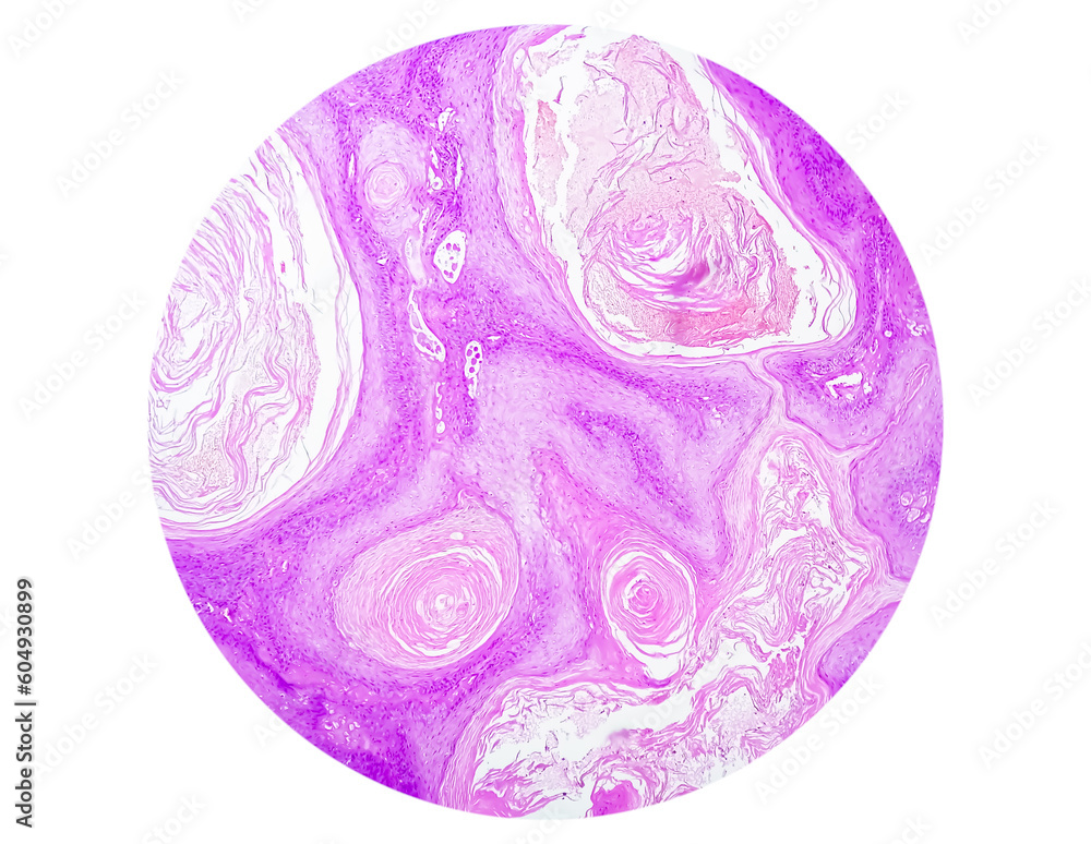 Photomicrography of Squamous hyperplasia of Right Lower Bucco Areola Photomicrography of Squamous hyperplasia of Right Lower Bucco Areola