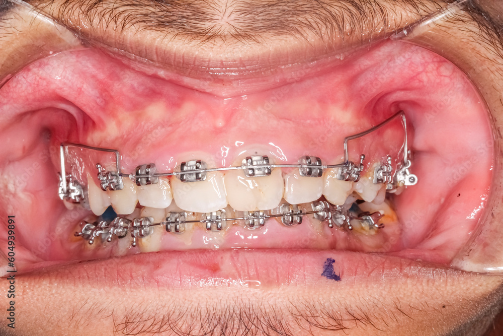 Frontal view of dental arches in biting teeth occlusion, orthodontic