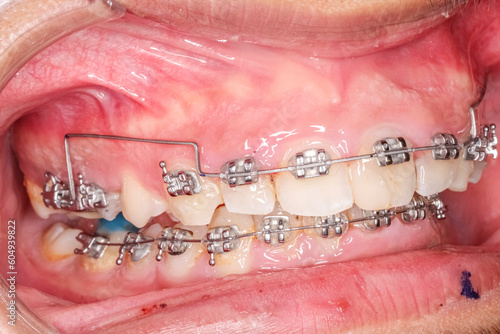 Lateral oblique view of dental arches in biting teeth occlusion with molar bite-raising blue resin material, orthodontic braces, arch wire, healthy gingival gum, lips retracted with cheek retractor.