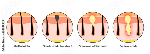 Acne treatment poster