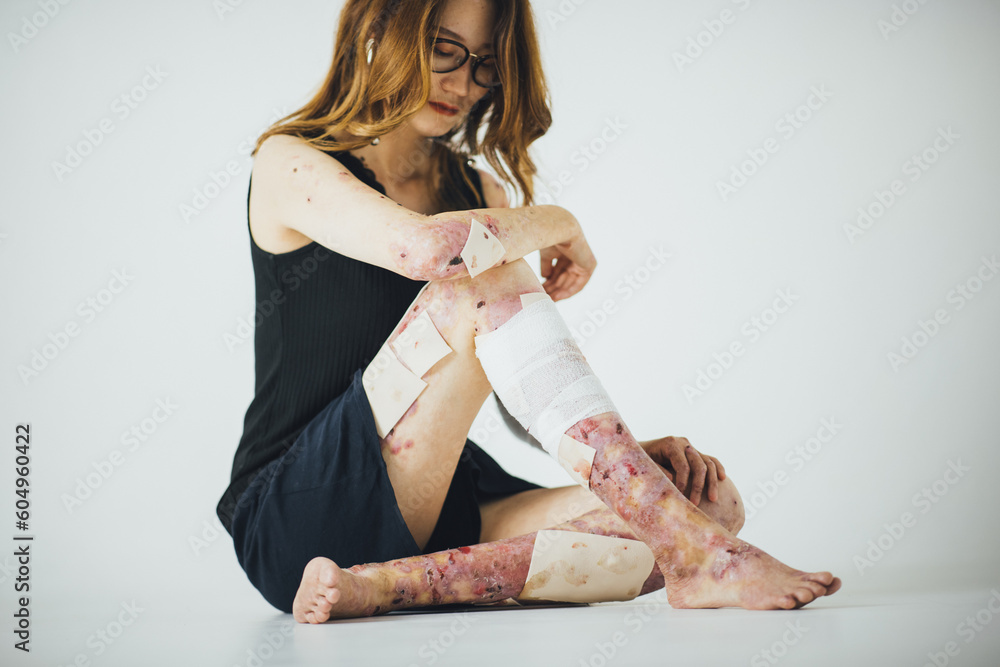Φωτογραφία 白い背景で堂々と自分を表現する皮膚の難病をもつ女性