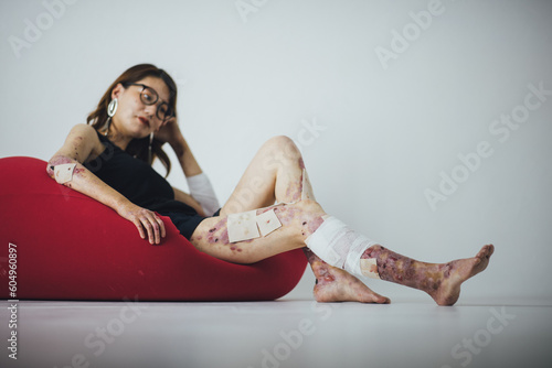 Fototapeta Naklejka Na Ścianę i Meble -  赤いクッションに座り自分の症状をカメラの前で表現する難病の女性