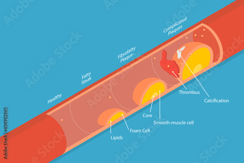 3D Isometric Flat Vector Conceptual Illustration of Stage Of Atherosclerosis, Cardiovascular Disease photo