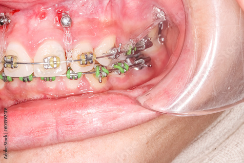 Frontal view of dental arches in biting teeth occlusion, orthodontic braces, elastic O-ring ligature, archwire, cheeks and lips retracted with cheek retractor. Mini-implants in healthy gingival gum.