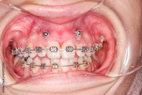 Frontal view of dental arches in biting teeth occlusion, orthodontic braces, elastic O-ring ligature, arch wire, cheeks and lips retracted with cheek retractor. Mini-implants in healthy gingival gum.